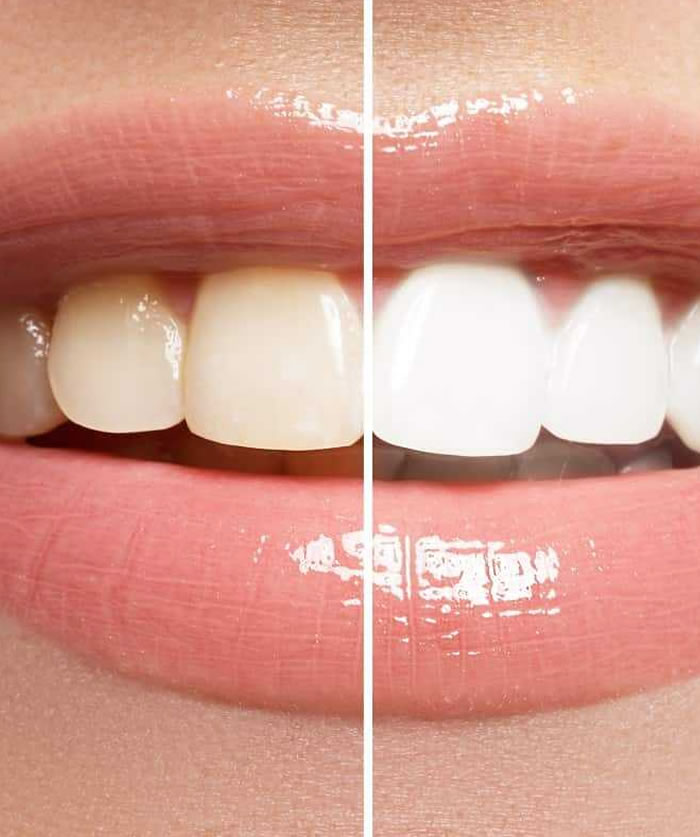 What is Teeth Whitening? How Is It Done? What are the Advantages?