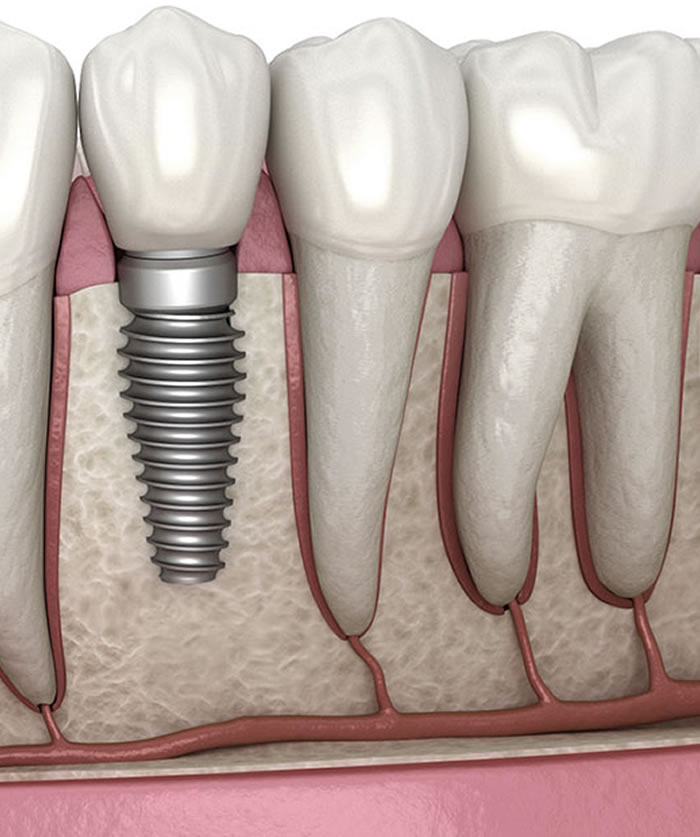 Implant Treatment, Implant Lifespan without Surgery and How Many Months Does the Implant Heal?